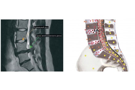 CT and NLS-diagnostics of degenerative-dystrophic damages  of intervertebral disks