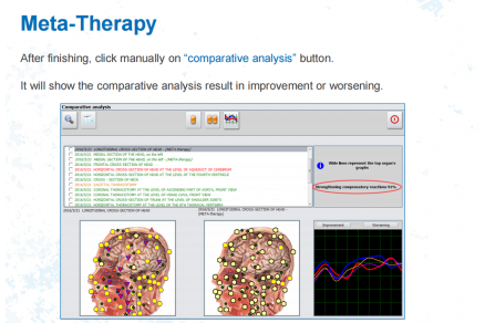 The Meta Therapy Of Bioresonance NLS Device