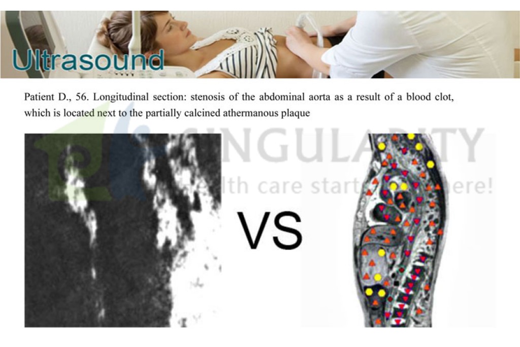 How does Bioplasm treat uterine fibroids（two）