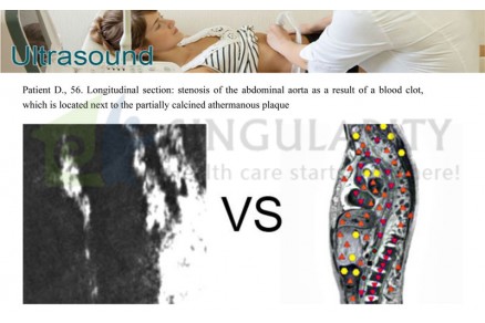 How does Bioplasm treat uterine fibroids（two）
