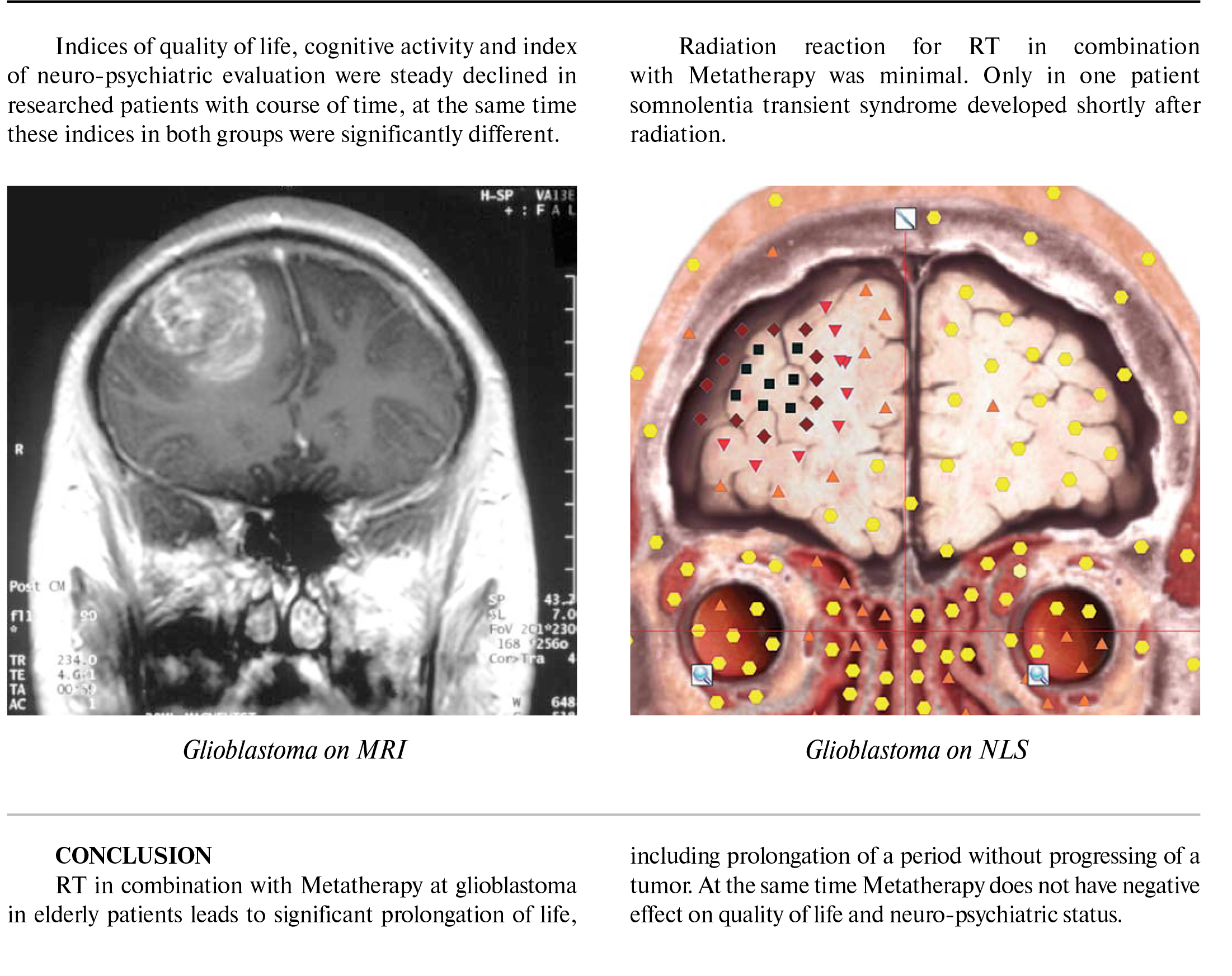 Combined radiation therapy and metatherapy of glioblastoma in elderly